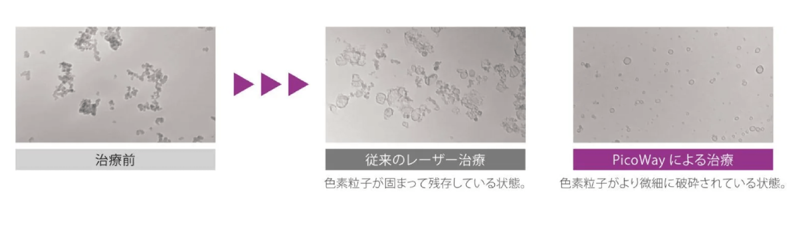 ピコレーザーとは